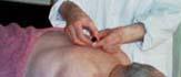 China Acupuncture & Herbal Clinic Port Coquitlam and Burnaby treatment image